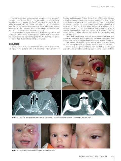 Microbial keratitis in southeast Brazil Floppy eyelid syndrome ...