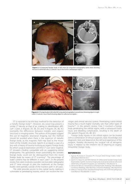 Monovision and cataract surgery Visual field and OCT correlation ...