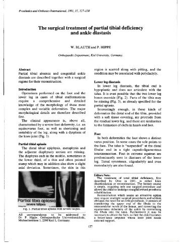 The surgical treatment of partial tibial deficiency and ankle diastasis