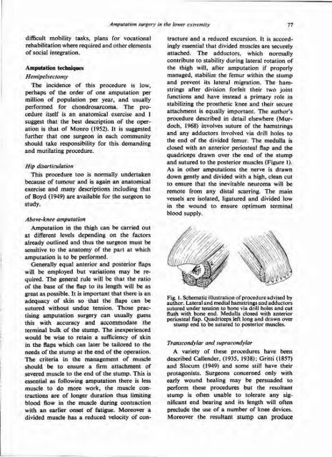 Amputation surgery in the lower extremity