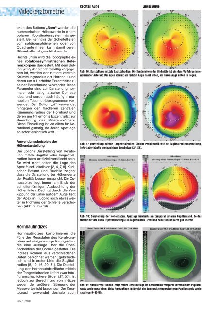 Möglichkeiten der Hornhautdiagnostik - Oculus