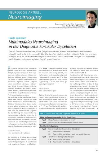 Multimodales Neuroimaging in der Diagnostik kortikaler Dysplasien