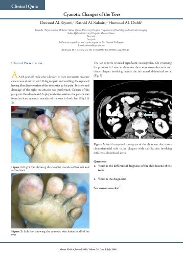 Cyanotic Changes of the Toes Clinical Quiz - OMJ