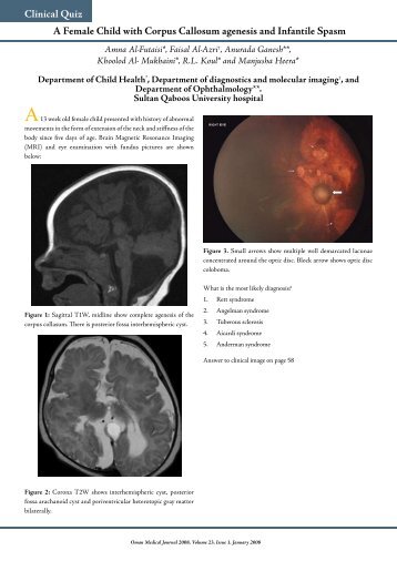 Clinical Quiz A Female Child with Corpus Callosum agenesis ... - OMJ