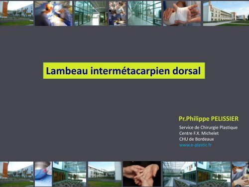 Lambeau intermÃ©tacarpien dorsal - e-plastic.fr