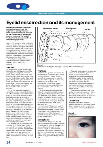 Eyelid misdirection and its management