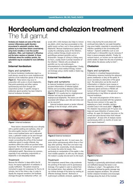 Hordeolum and chalazion treatment The full gamut