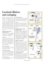 Lacrimal dilation and syringing - Optometry Today