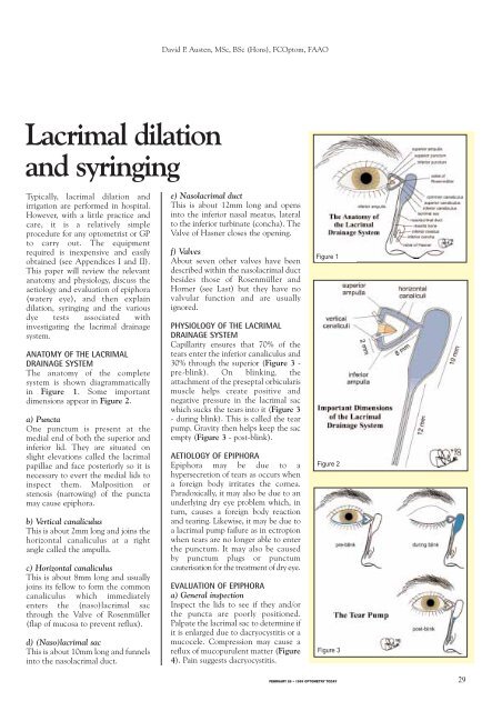 Lacrimal dilation and syringing - Optometry Today