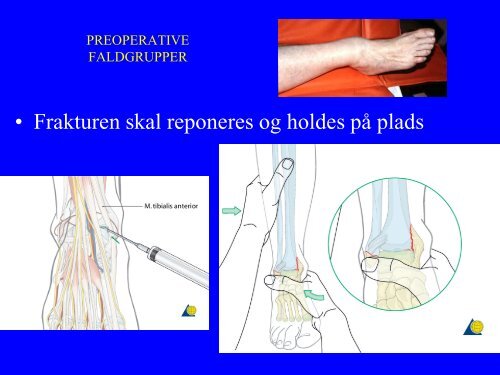 Svar pÃ¥ et par spÃ¸rgsmÃ¥l vedrÃ¸rende malleolfrakturer.