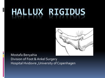 Hallux Rigidus