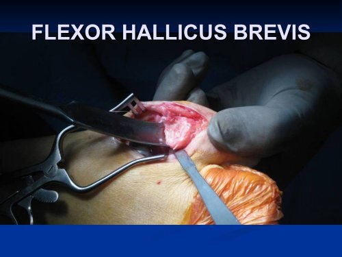 Hallux Rigidus