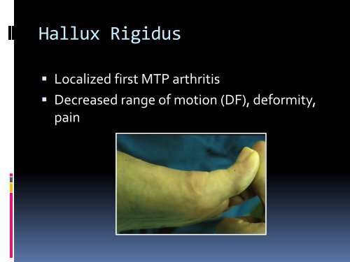 Hallux Rigidus