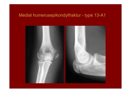 Distale humerusfrakturer Fractura pars distalis humeri