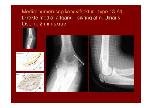 Distale humerusfrakturer Fractura pars distalis humeri