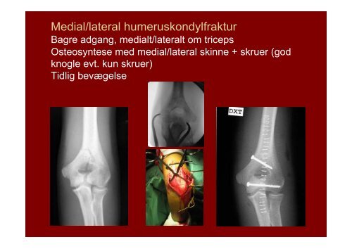 Distale humerusfrakturer Fractura pars distalis humeri