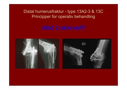 Distale humerusfrakturer Fractura pars distalis humeri