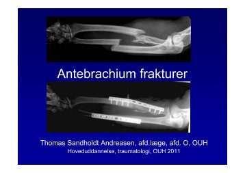 Antebrachium frakturer