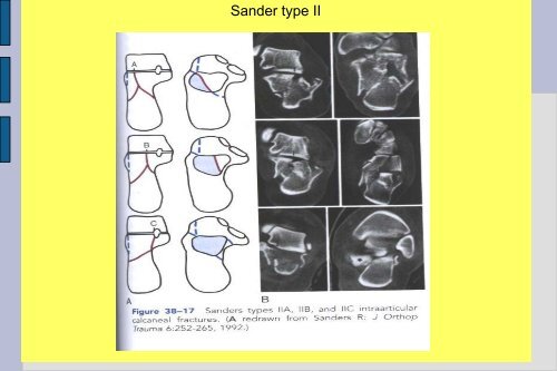 Frakturer og luksationer: calcaneus, talus, naviculare, Chopart ...