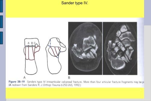 Frakturer og luksationer: calcaneus, talus, naviculare, Chopart ...