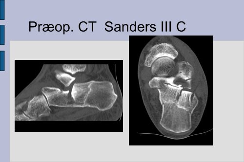 Frakturer og luksationer: calcaneus, talus, naviculare, Chopart ...