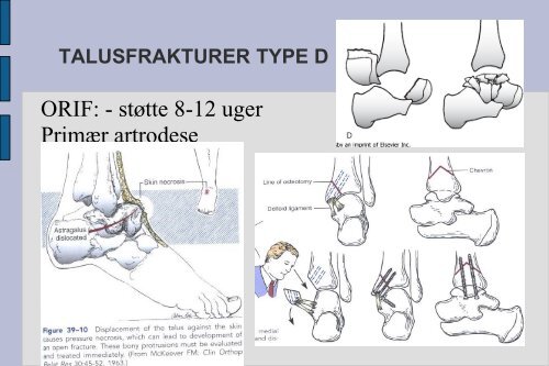 Frakturer og luksationer: calcaneus, talus, naviculare, Chopart ...