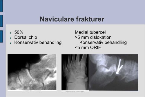 Frakturer og luksationer: calcaneus, talus, naviculare, Chopart ...