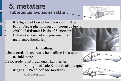 Frakturer og luksationer: calcaneus, talus, naviculare, Chopart ...