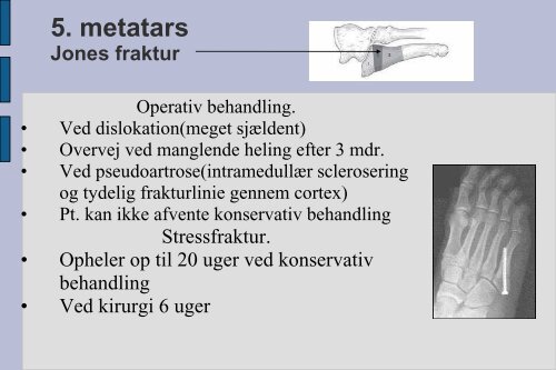 Frakturer og luksationer: calcaneus, talus, naviculare, Chopart ...