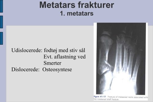 Frakturer og luksationer: calcaneus, talus, naviculare, Chopart ...