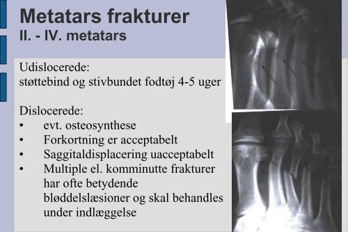 Frakturer og luksationer: calcaneus, talus, naviculare, Chopart ...