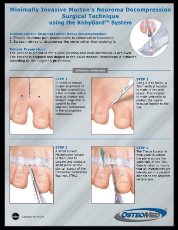 Minimally Invasive Morton's Neuroma Decompression ... - OsteoMed