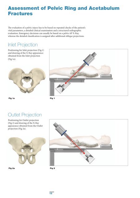 Pelvic & Acetabular Fracture Treatment Solutions - Stryker