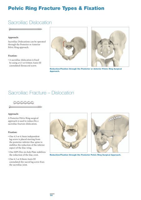 Pelvic & Acetabular Fracture Treatment Solutions - Stryker