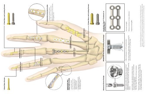 Stryker Hand Plating System Flyer