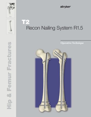 osteosynthesis stryker recon nail The t2 recon nail is the latest development for the treatment of proximal hip and diaphyseal femoral fractures. osteosynthesis stryker recon nail The t2 recon nail is the latest development for the treatment of proximal hip and diaphyseal femoral fractures.