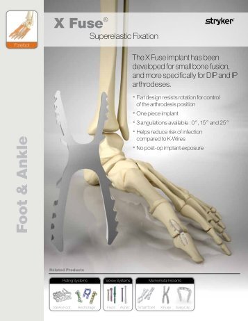 X Fuse Superelastic Fixation Sales Sheet - Stryker