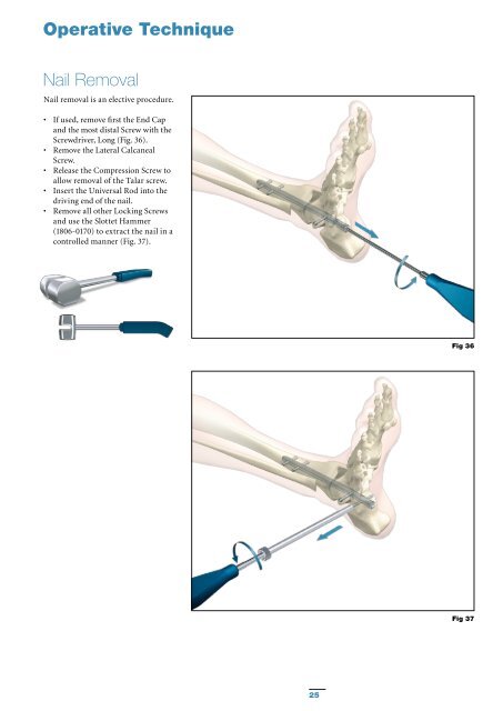 T2 Ankle Arthrodesis Nail - Stryker