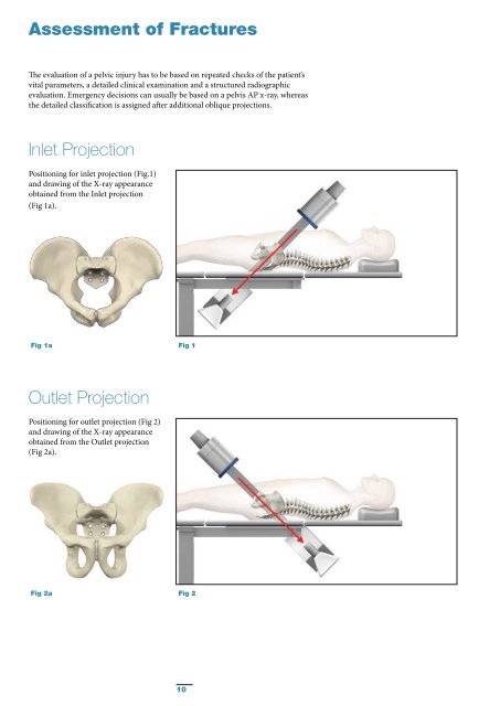 Pelvic & Acetabular Fracture Treatment - Stryker