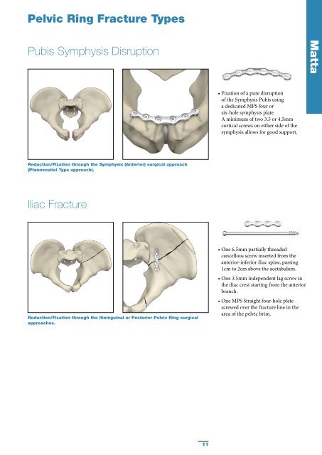 Pelvic & Acetabular Fracture Treatment - Stryker