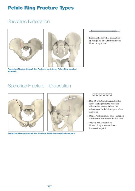 Pelvic & Acetabular Fracture Treatment - Stryker