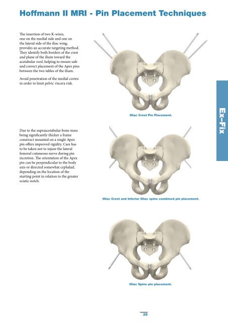 Pelvic & Acetabular Fracture Treatment - Stryker