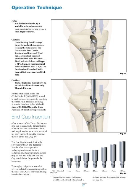 T2 Tibial Nailing System - Stryker