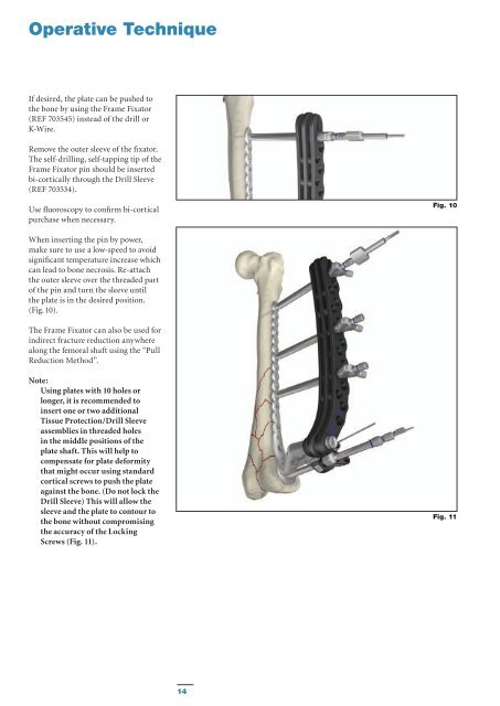 AxSOS Targeting System Distal Lateral Femur Operative - Stryker
