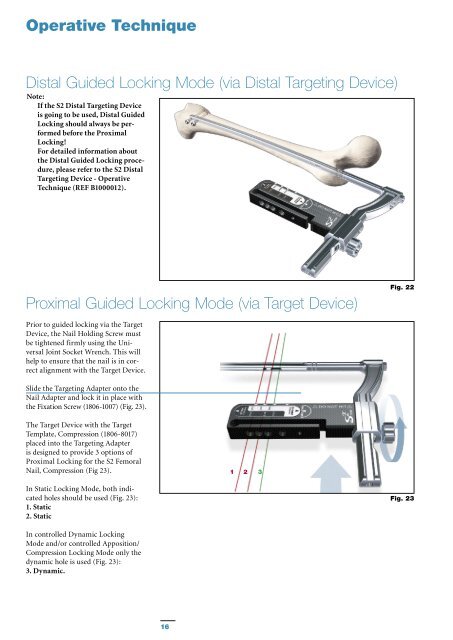 S2 Femoral Nail Compression Operative Technique - Stryker