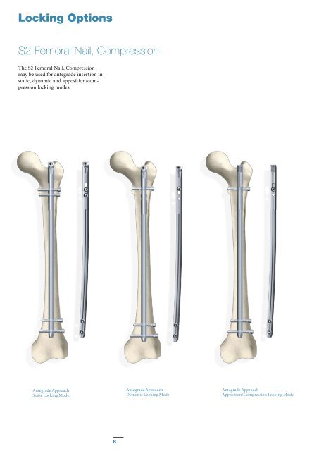 S2 Femoral Nail Compression Operative Technique - Stryker