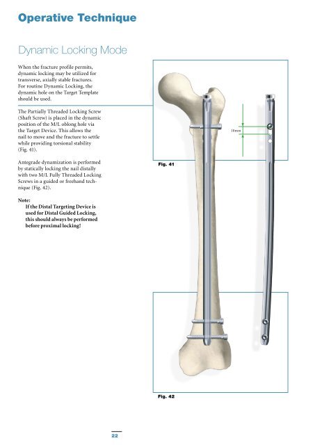 S2 Femoral Nail Compression Operative Technique - Stryker