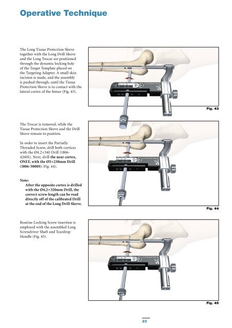 S2 Femoral Nail Compression Operative Technique - Stryker