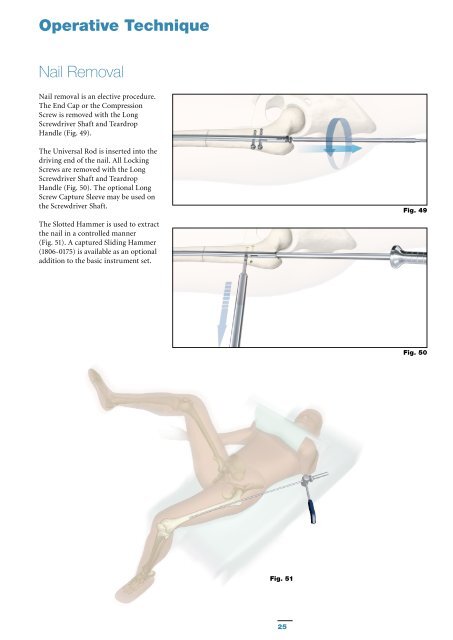 S2 Femoral Nail Compression Operative Technique - Stryker