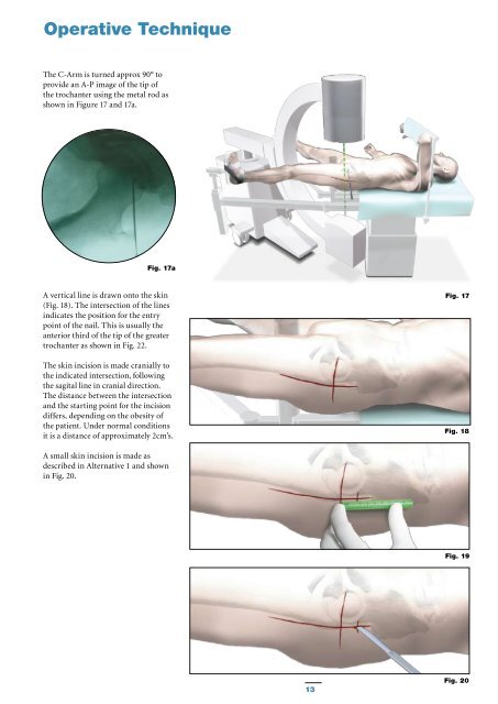 Gamma3 Trochanteric Nail 180 - Stryker